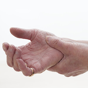 Arthritis